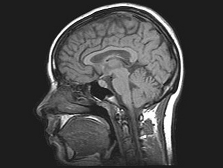 Eine MRT-Aufnahme eines Gehirns