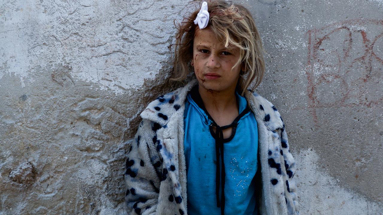 Ein im Bürgerkrieg im syrischen Aleppo verletztes Mädchen steht vor einer Mauer.