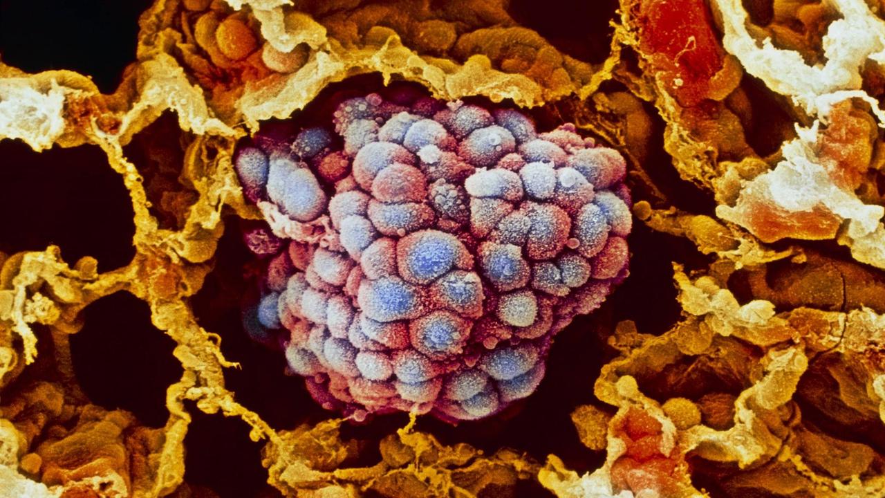 Kolorierte Aufnahme eines Lungen-Tumors unter dem Rasterelektronenmikroskop