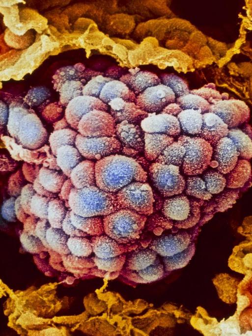 Kolorierte Aufnahme eines Lungen-Tumors unter dem Rasterelektronenmikroskop