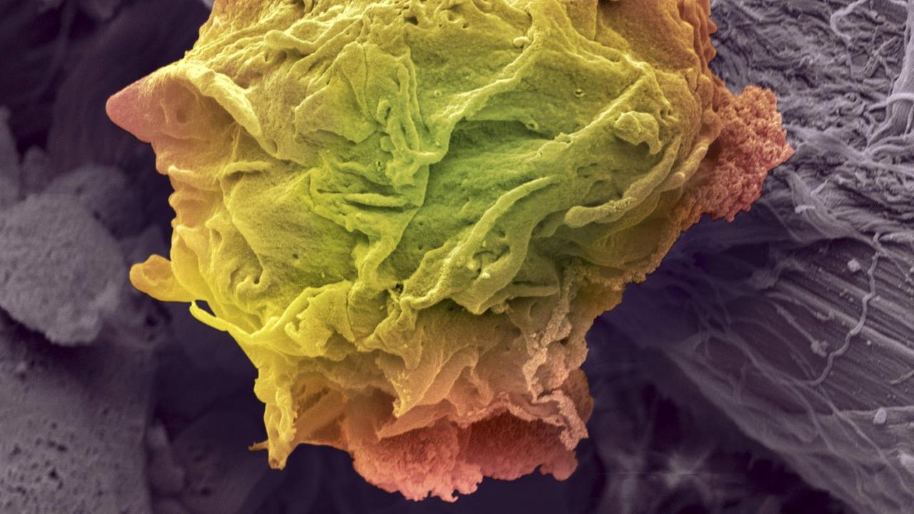 Lymphoma cancer cell SEM Lymphoma cancer cell Coloured scanning electron micrograph SEM of a lym
Lymphdrüsenkrebs, Farbiger Scan einer elektronischen Mikrograpfie