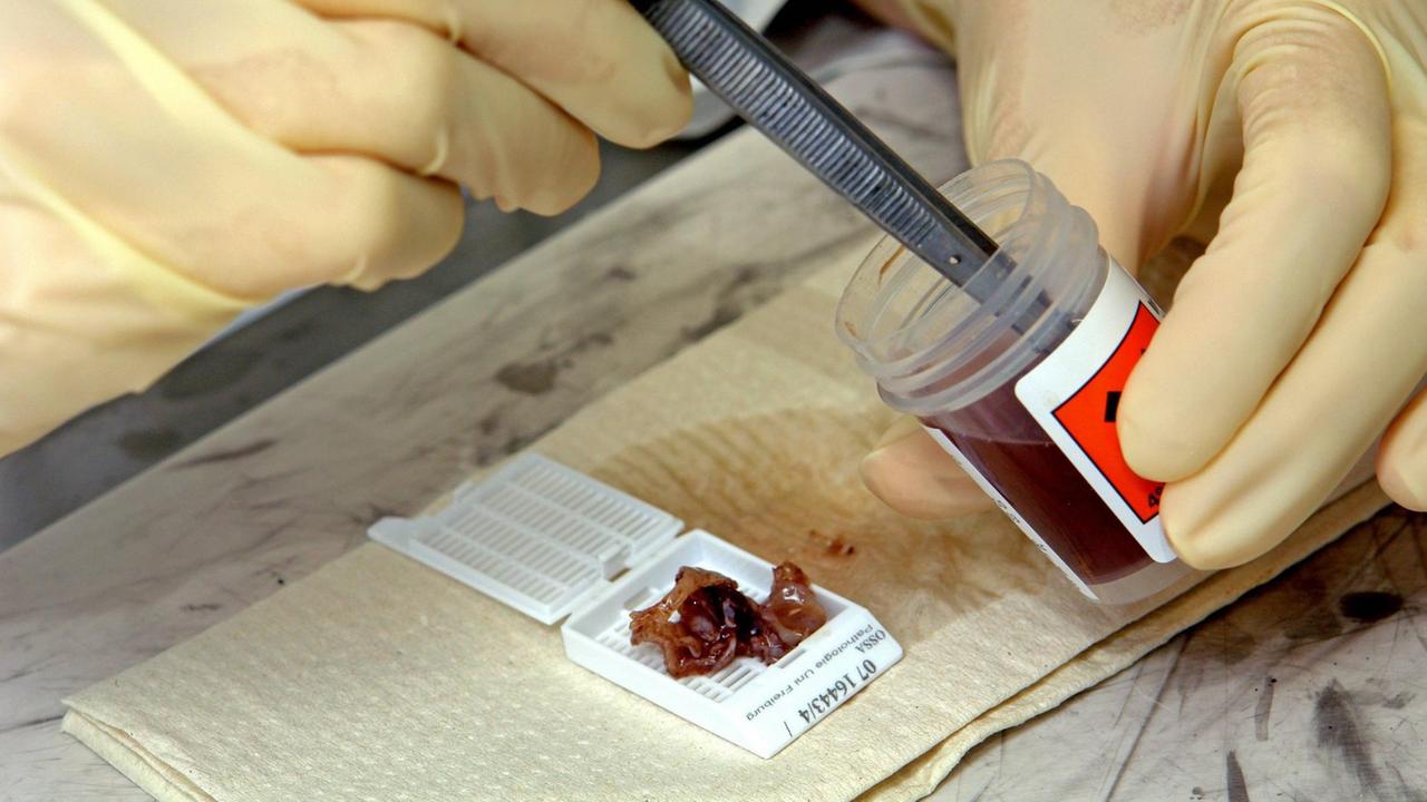Ein Pathologe der Uni Freiburg entnimmt eine Gewebeprobe aus einem Behälter.