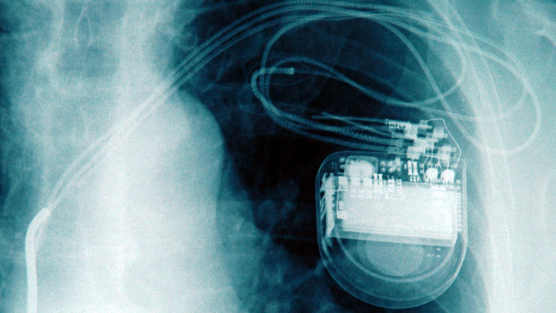Auf dem Röntgenbild eines Brustkorbs ist ein implantierter Herzschrittmacher zu erkennen