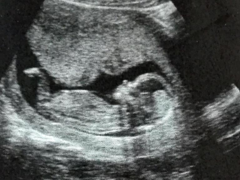 Ein Ultraschallbild. Zu sehen ist das Baby im Mutterleib.