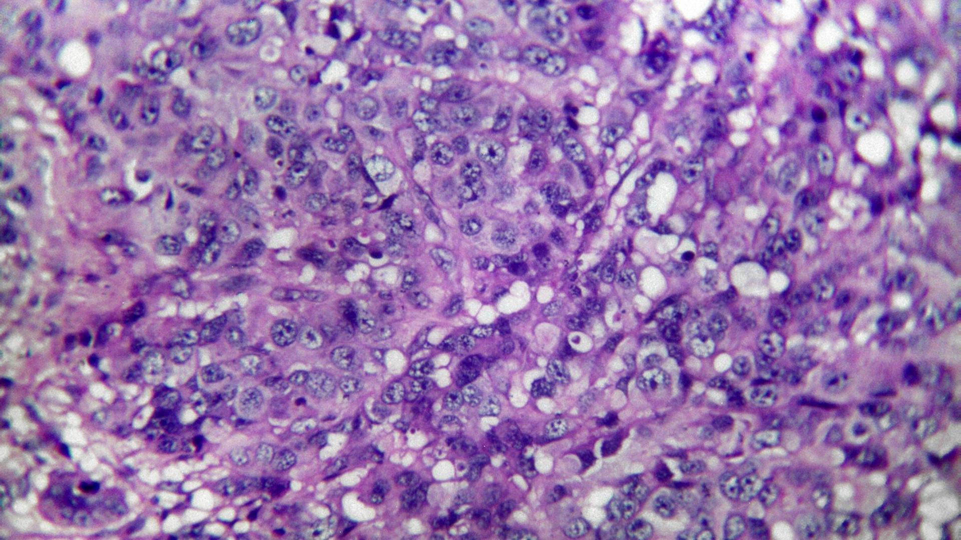 Gewebe eines Melanosarkoms der Haut, mikroskopischer Schnitt, 400-fache Vergrößerung