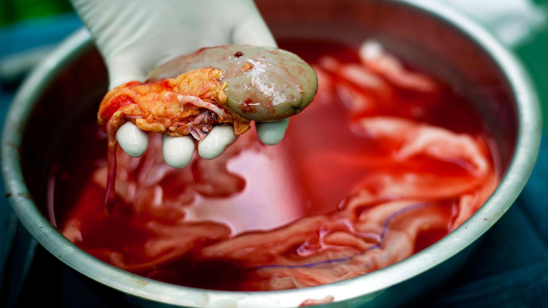 Eine zur Transplantation vorgesehene Niere wird von einer behandschuhten Hand aus einer Metallschüssel genommen.