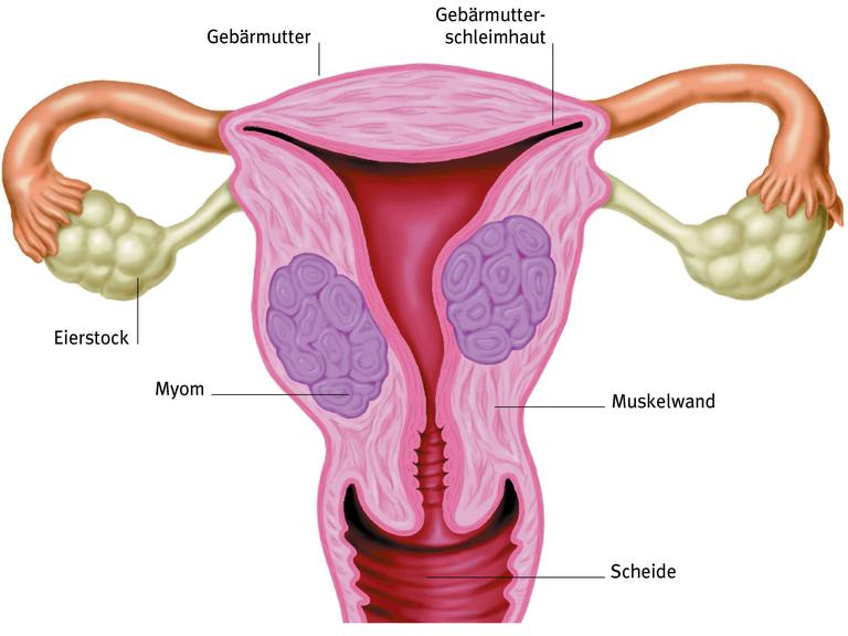 Gebärmuttermyome sind die häufigsten gutartigen Tumore im weiblichen Genitaltrakt.