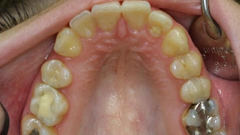 Plomben könnten bald durch nachgewachsenen Zahnschmelz abgelöst werden.