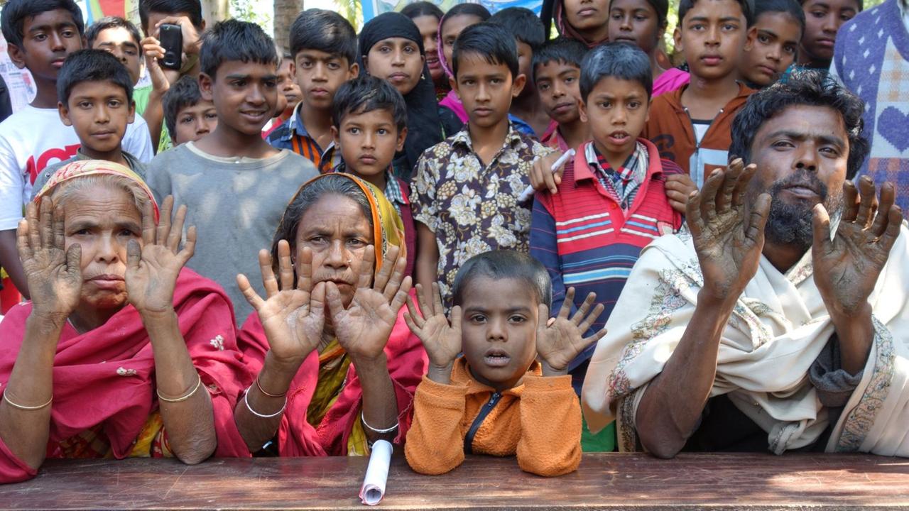 Das sichtbarste Zeichen einer Arsen-Vergiftung sind rissige und wunde Hände. Viele Dorfbewohner in Bangladesch leiden durch ihr Brunnenwasser darunter und halten ihre Hände hoch.