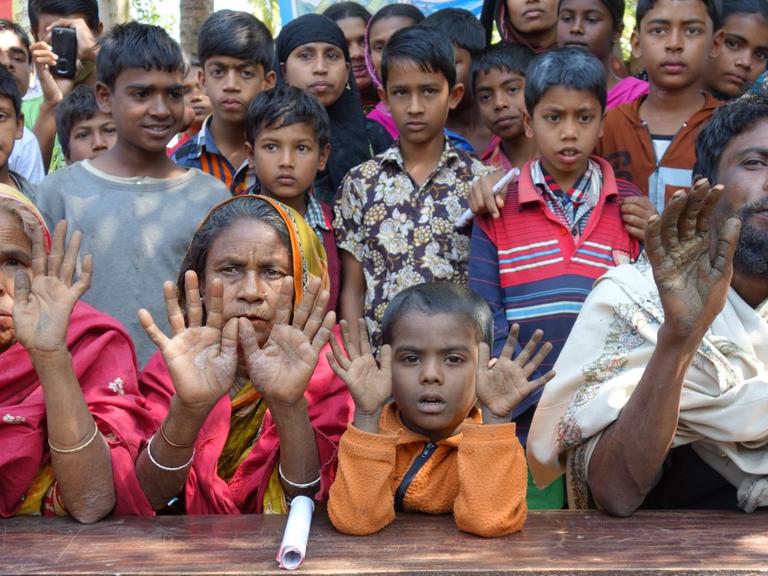 Das sichtbarste Zeichen einer Arsen-Vergiftung sind rissige und wunde Hände. Viele Dorfbewohner in Bangladesch leiden durch ihr Brunnenwasser darunter und halten ihre Hände hoch.