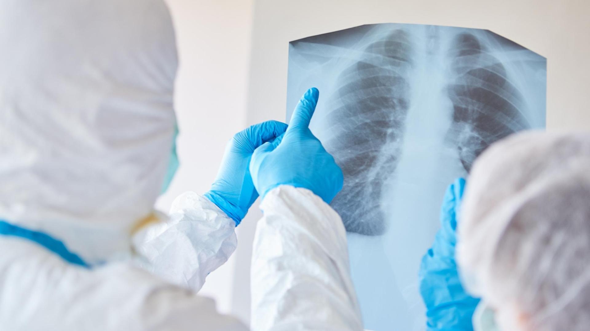 Ärzte in Schutzkleidung schauen sich ein Röntgenbild einer Lungenentzündung eines COVID-19 Patient an