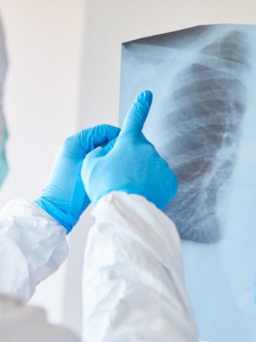 Ärzte in Schutzkleidung schauen sich ein Röntgenbild einer Lungenentzündung eines COVID-19 Patient an