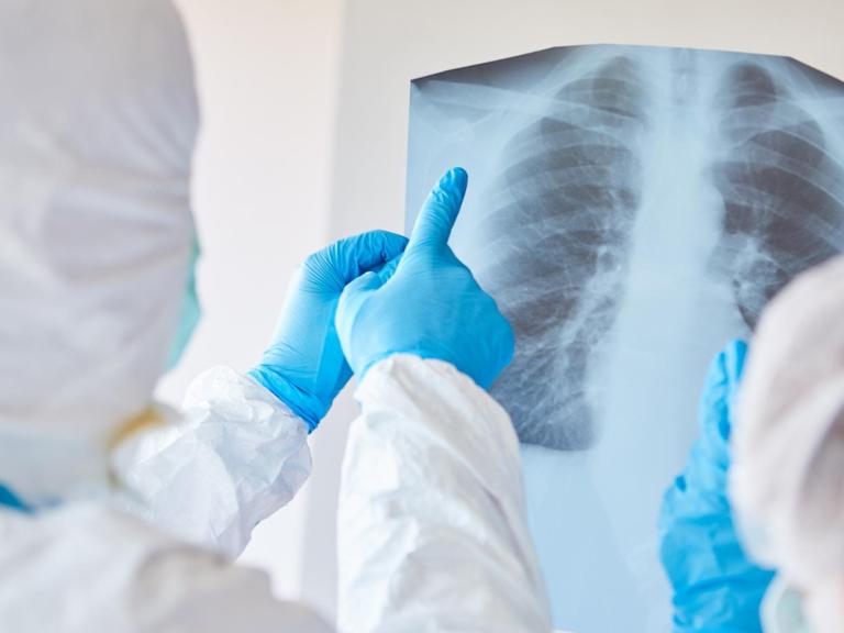 Ärzte in Schutzkleidung schauen sich ein Röntgenbild einer Lungenentzündung eines COVID-19 Patient an