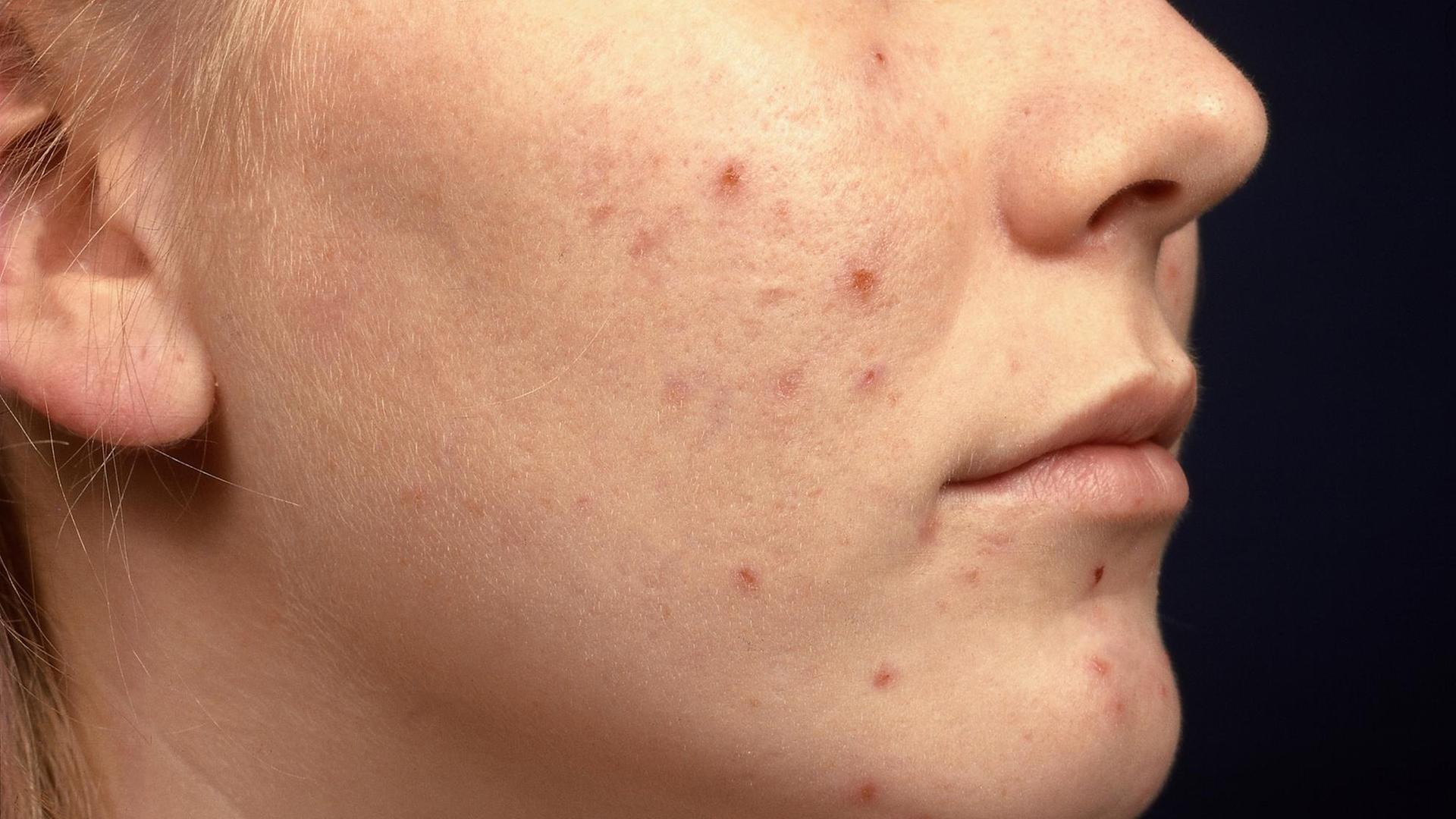 Medizin Dermatologie Akne Erosionen mit Krusten in Gesicht von Patientin Hauterkrankung medicine dermatology acne Acne excoriee des jeunes filles | Verwendung weltweit