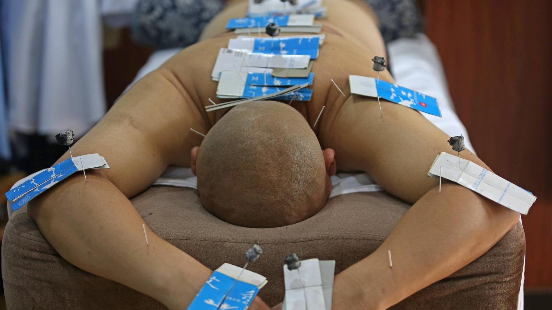 Ein Mann liegt auf einer Massageliege mit Akupunkturnadeln in seinem Körper.