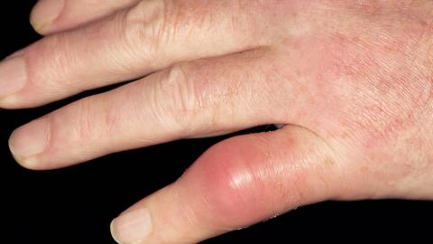 Eine Hand mit Gichtbefall am kleinen Finger.