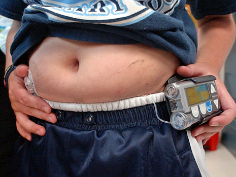 Eine Insulinpumpe versorgt einen Diabetes-Patienten mit Insulin