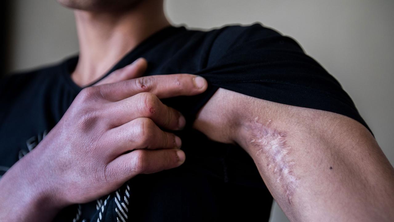 Ein ehemaliger, junger IS-Kämpfer zeigt eine Narbe.