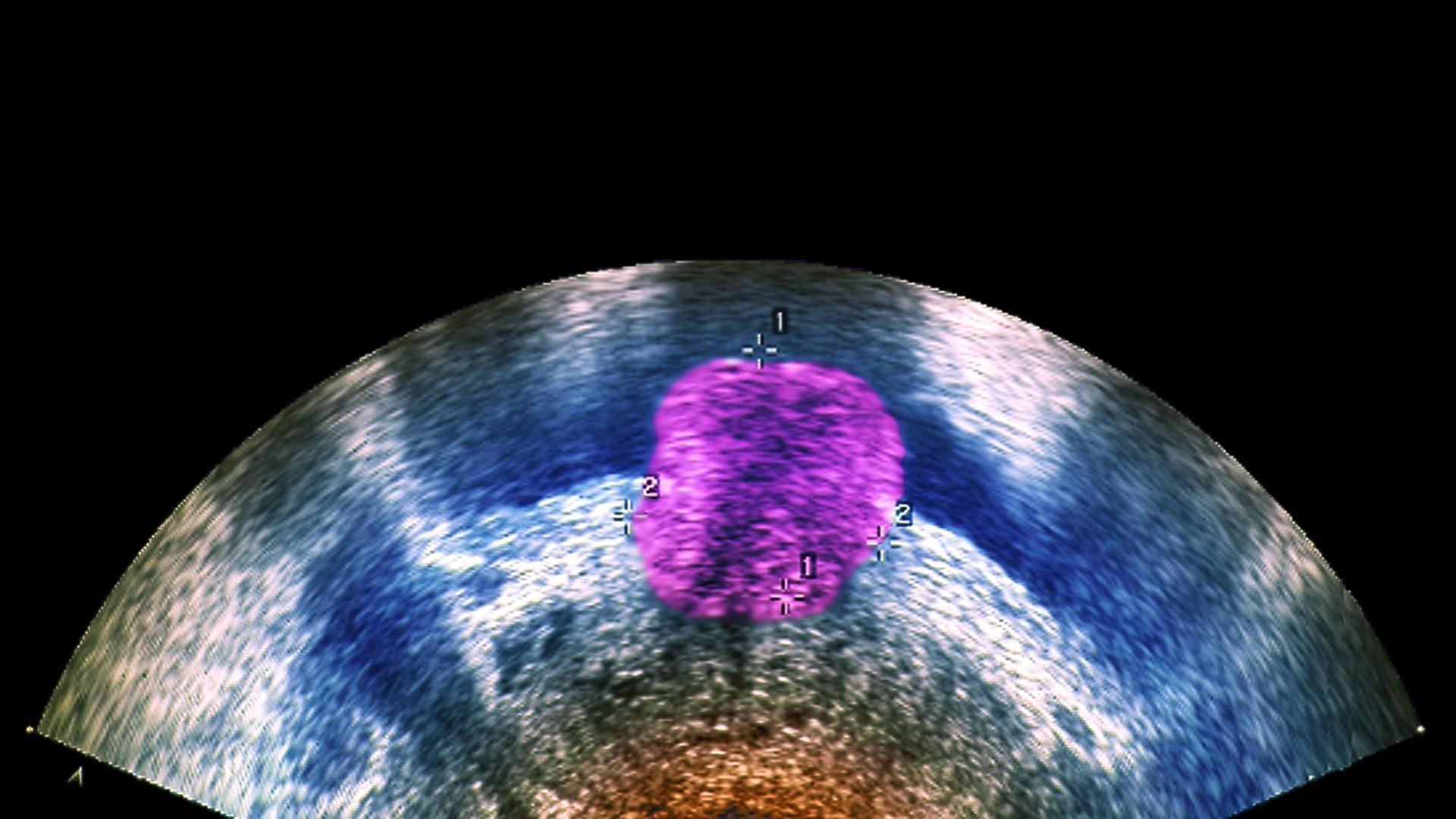 Ein Ultraschallbild eines Prostata-Tumors Prostata Krebs Männer Ultraschall Urologe Urologie