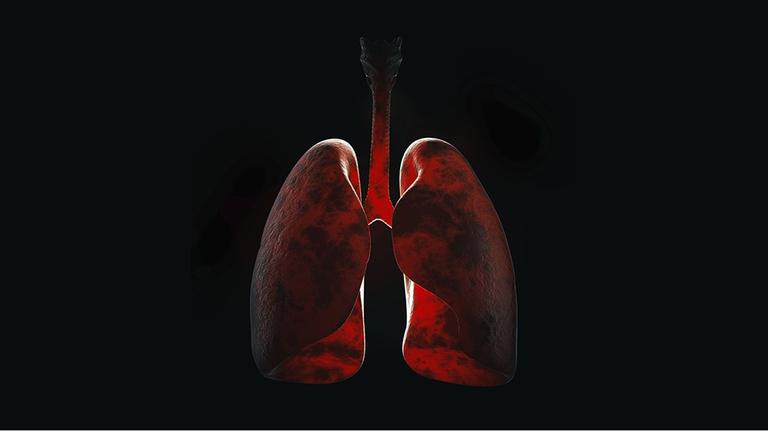 Illustration einer Lungeninfektion