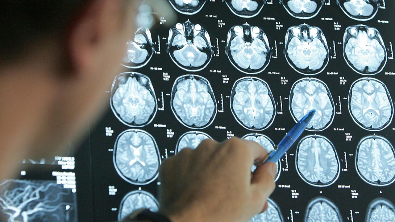 Der Arzt der Kinderonkologie deutet mit einem Kugelschreiber auf Bilder eines Magnet-Resonanz-Tomographen (MRT), die verschiedene Gehirnquerschnitte einer jungen Schlaganfall-Patientin.

