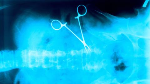 Gestellte Aufnahme: Auf einem Röntgenbild ist eine vergessene OP-Klemme im Bauchraum eines Patienten zu sehen.