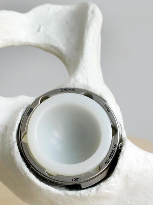 Ein Teil einer Hüftprothese, der durch ein scharfes Gewinde direkt in den Knochen geschraubt werden kann, ist am 19.06.2007 bei der aap Implantate AG in Berlin so zu sehen, dass die Verankerung in der Hüfte deutlich wird.