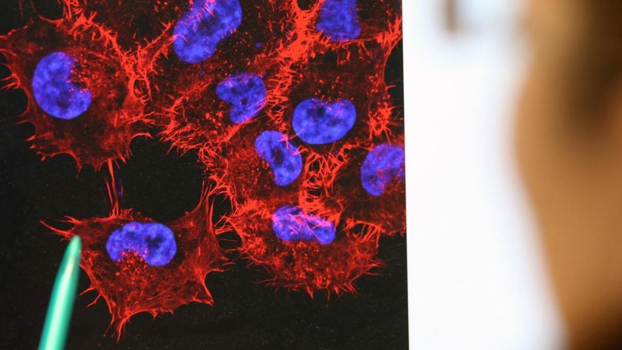 Im Labor des Instituts für Experimentelle Gentherapie und Tumorforschung (IEGT) der Universitätsmedizin Rostock (Mecklenburg-Vorpommern) schaut eine Doktorandin am 22.10.2013 auf ein Monitorbild von Melanom-Zellen (schwarzer Hautkrebs).