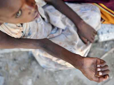 Ein unterernährtes Kind wartet auf medizinische Versorgung in Mogadischu Ein unterernährtes Kind wartet auf medizinische Versorgung in Mogadischu