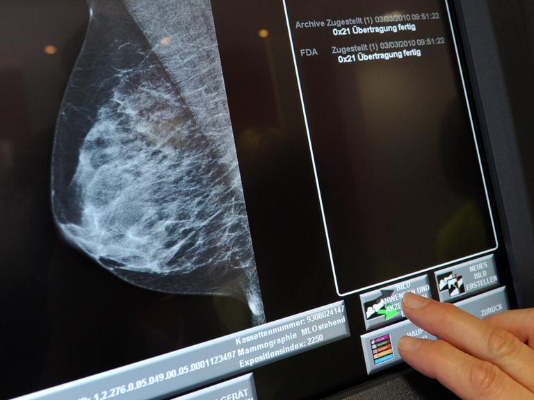 Eine Medizinisch-technische Radiologieassistentin (MTRA) überprüf in Hannover in dem Mammografie Screening Zentrum die Aufnahme einer Brust.