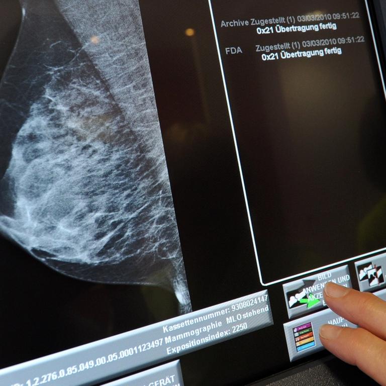 Eine Medizinisch-technische Radiologieassistenten (MTRA) überprüft am Donnerstag (04.03.2010) in Hannover in dem Mammografie Screening Zentrum eine Aufnahme einer Brust.