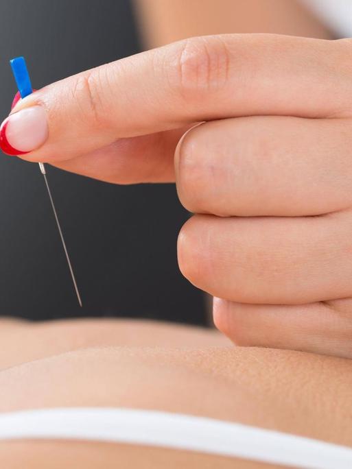 Akupunkturbehandlung: Eine Frau sticht einer Patientin mehrere Nadeln in den Rücken.