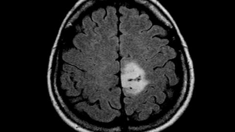 Das MRT-Bild des Gehirntumors (heller Fleck)