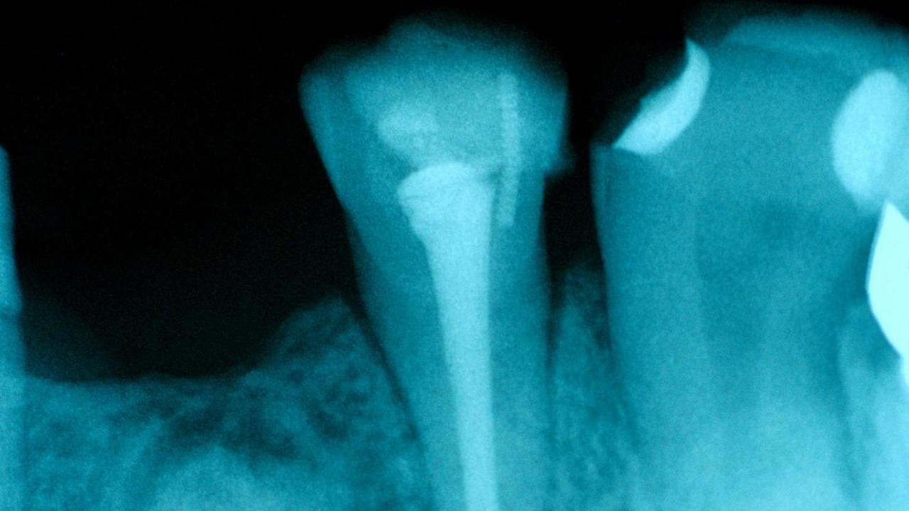 Rötngenaufnahme eines Zahns nach einer Wurzelbehandlung