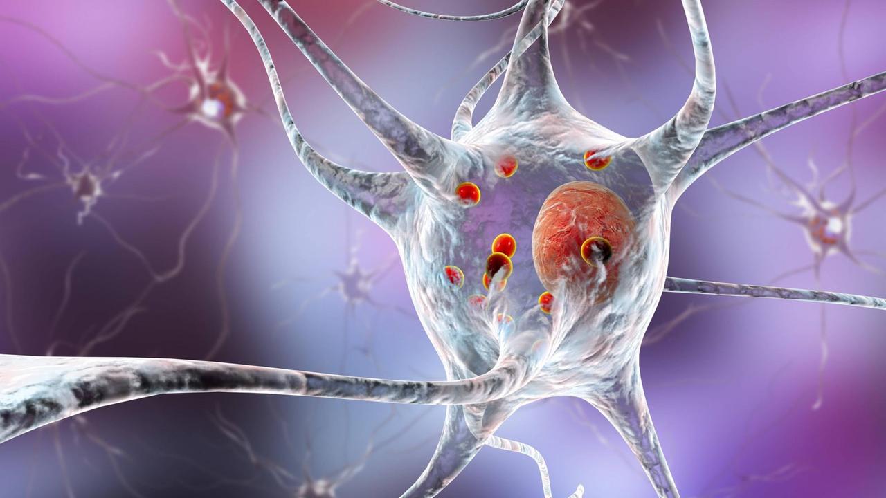 Illustration einer Parkinson-geschädigten Nervenzelle. Die roten Punkte sind die sogenannten Lewy-Körper - die Proteinablagerungen führen zum Absterben der dopaminbildenden Neuronen