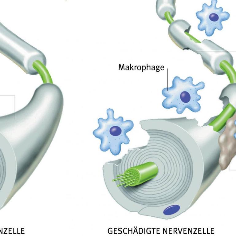 Die Illustration zeigt eine gesunde (l) und eine von Makrophagen geschädigte Nervenzelle (r).