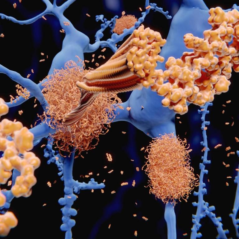 Illustration der Entstehung von Amyloid-Plaques (gelb) auf den Nervenzellen des Gehirns (blau)