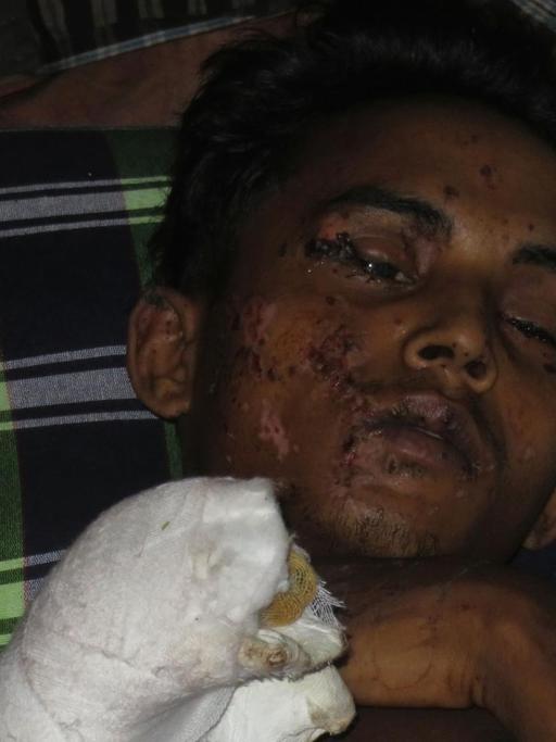 Der Rohingya Yusuf Nobi kann nichts mehr sehen, seine Füße wurden bei der Explosion zerfetzt. Er sagt, er sei an der Grenze von Myanmar zu Bangladesch auf eine Mine getreten. Oktober 2017