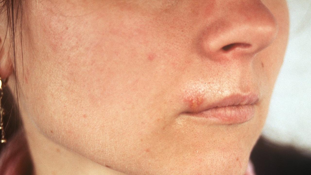 Hilft Gürtelrose-impfung Auch Gegen Lippenherpes www.deutschlandfunk.de