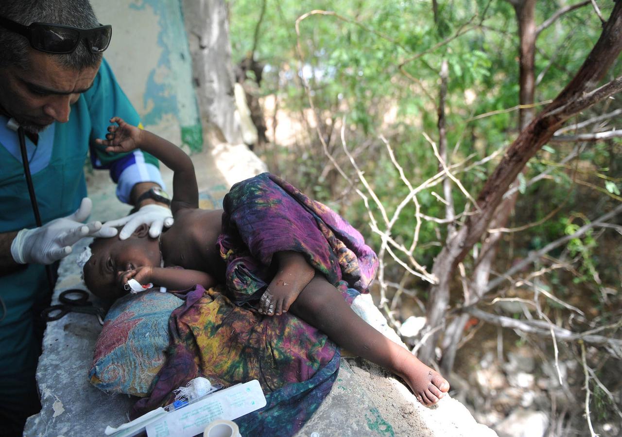 Ein südafrikanischer Arzt versorgt ein unterernährtes Kind in Somalia.