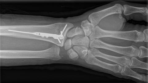  Ein Röntgenbild zeigt die Fraktur einer Speiche am Handgelenk die mit einem Metallimplantat verstärkt wurde.