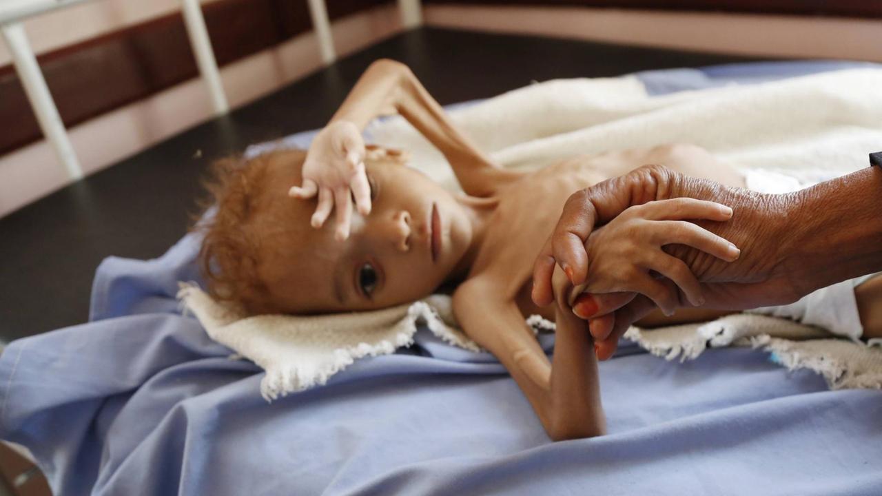 Ein akut unterernährtes Kind liegt auf einem Bett. Seine Hand wird von einer erwachsenen Hand gehalten.