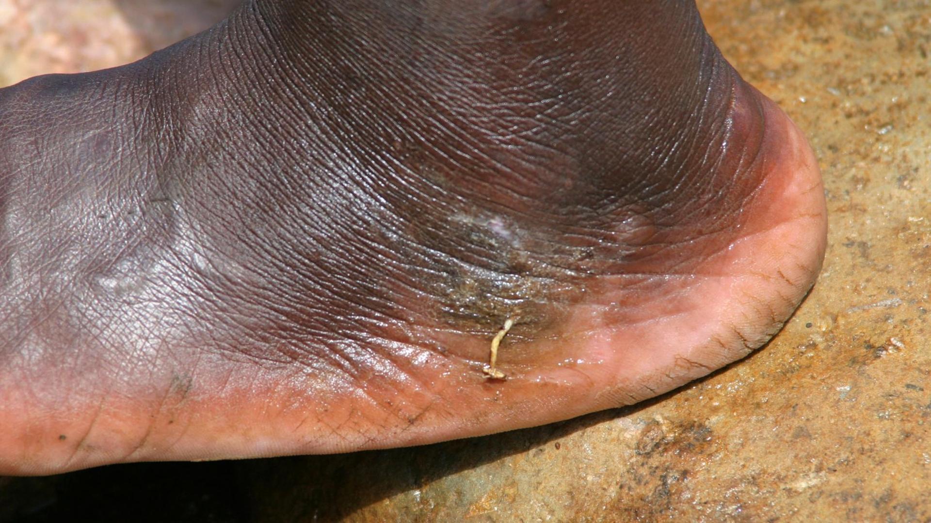 Ein Guineawurm oder Medina-Wurm tritt aus der Oberfläche eines Fußes aus.