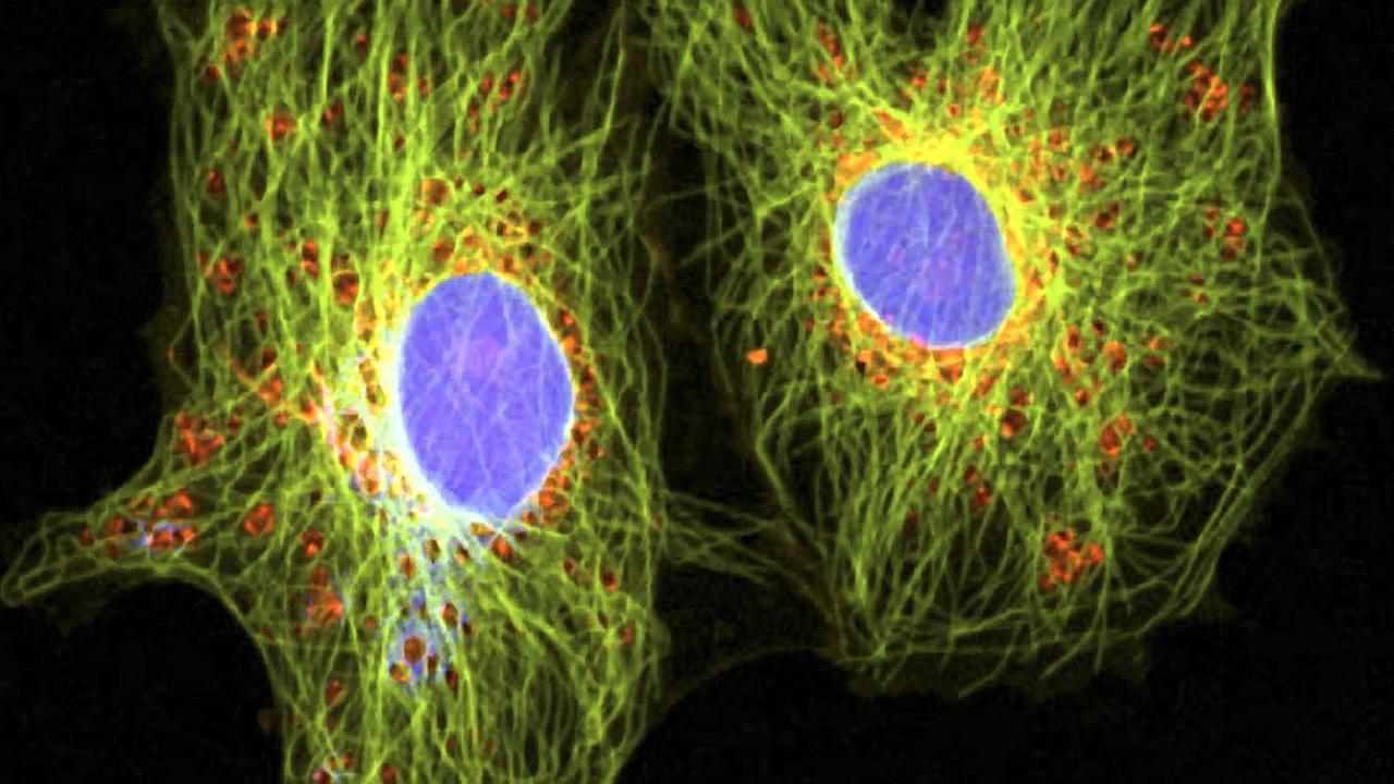 Krebszellen unterm Mikroskop: Unser Immunsystem bietet normalerweise effektiven Schutz durch sogenannte T-Zellen