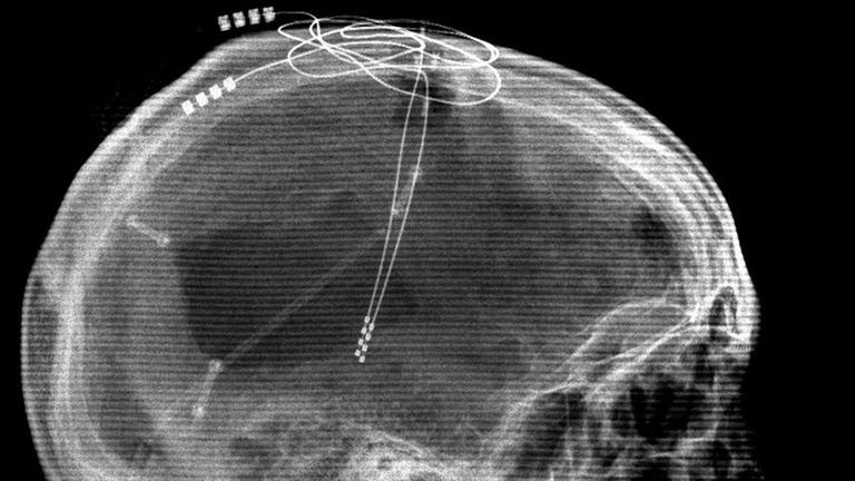Eine Röntgenaufnahme zeigt den Verlauf von Elektroden im Schädel. (undatiertes Handout)