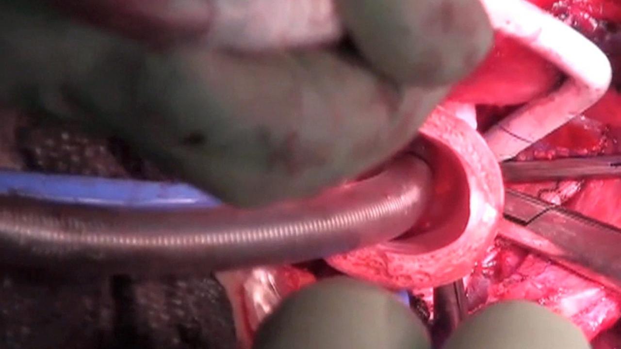 Die Transplantation einer synthetischen Luftröhre im Juli 2011