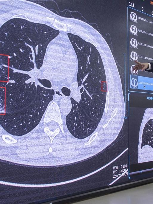 Ein Mann in Anzug und mit Maske zeigt auf einen an die Wand projizierten CT-Scan des Lungen/Brustbereichs.