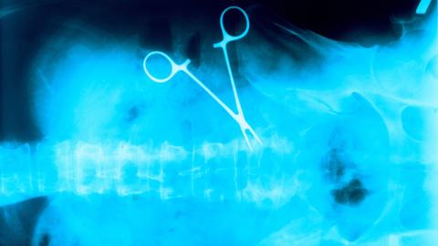 Gestellte Aufnahme: Auf einem Röntgenbild ist eine vergessene OP-Klemme im Bauchraum eines Patienten zu sehen.