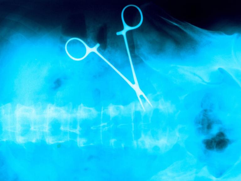 Gestellte Aufnahme: Auf einem Röntgenbild ist eine vergessene OP-Klemme im Bauchraum eines Patienten zu sehen.