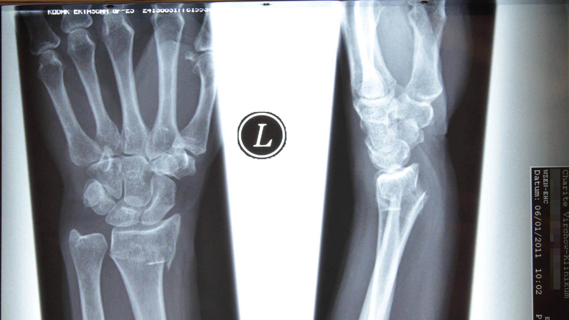 Das Bild zeigt in einer Röntgenaufnahme die Knochen einer Hand